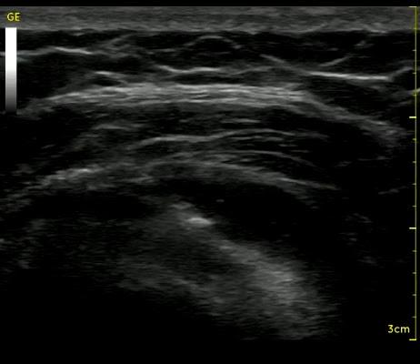 Έγχυση PRP σε μερική ρήξη υπερακανθίου