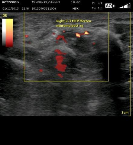 Νευρίνωμα του Morton
